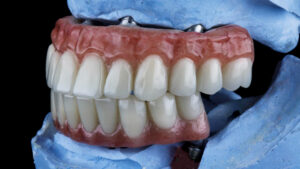 Implante dental vs. puente fijo: ¿Cuál te conviene más?