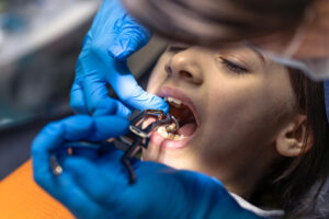 Implantes dentales: precios y qué factores influyen en su costo