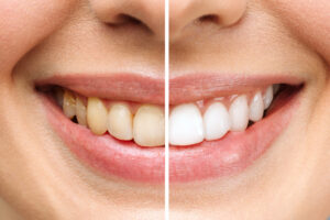 Blanqueamiento dental: mitos y verdades que debes conocer
