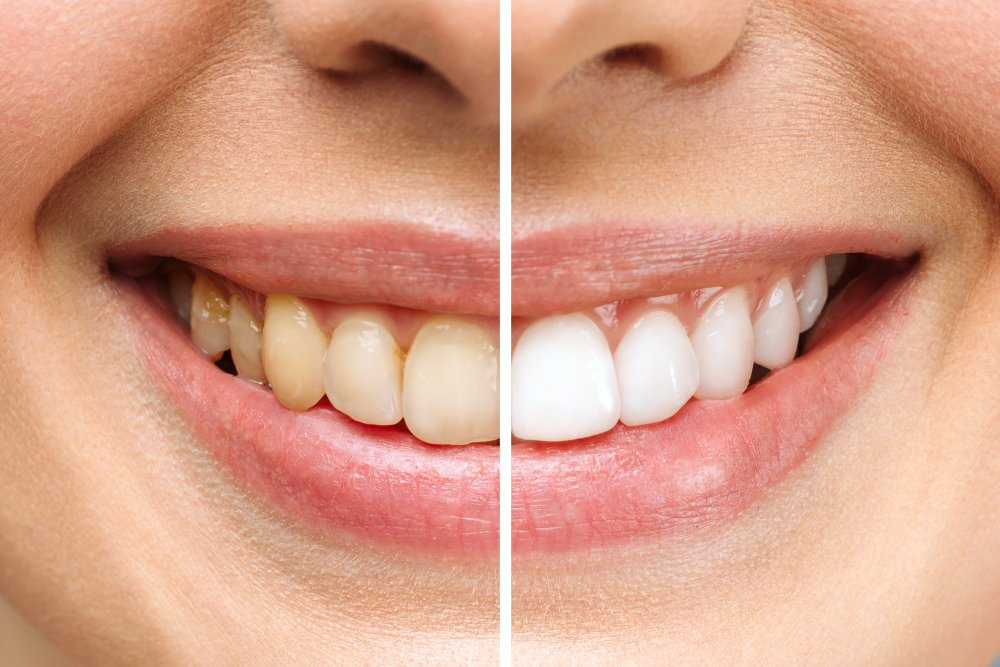 Blanqueamiento dental: mitos y verdades que debes conocer