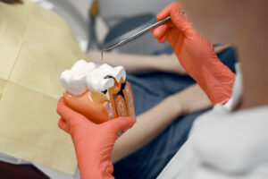Caries dentales: cómo prevenirlas y detectarlas a tiempo