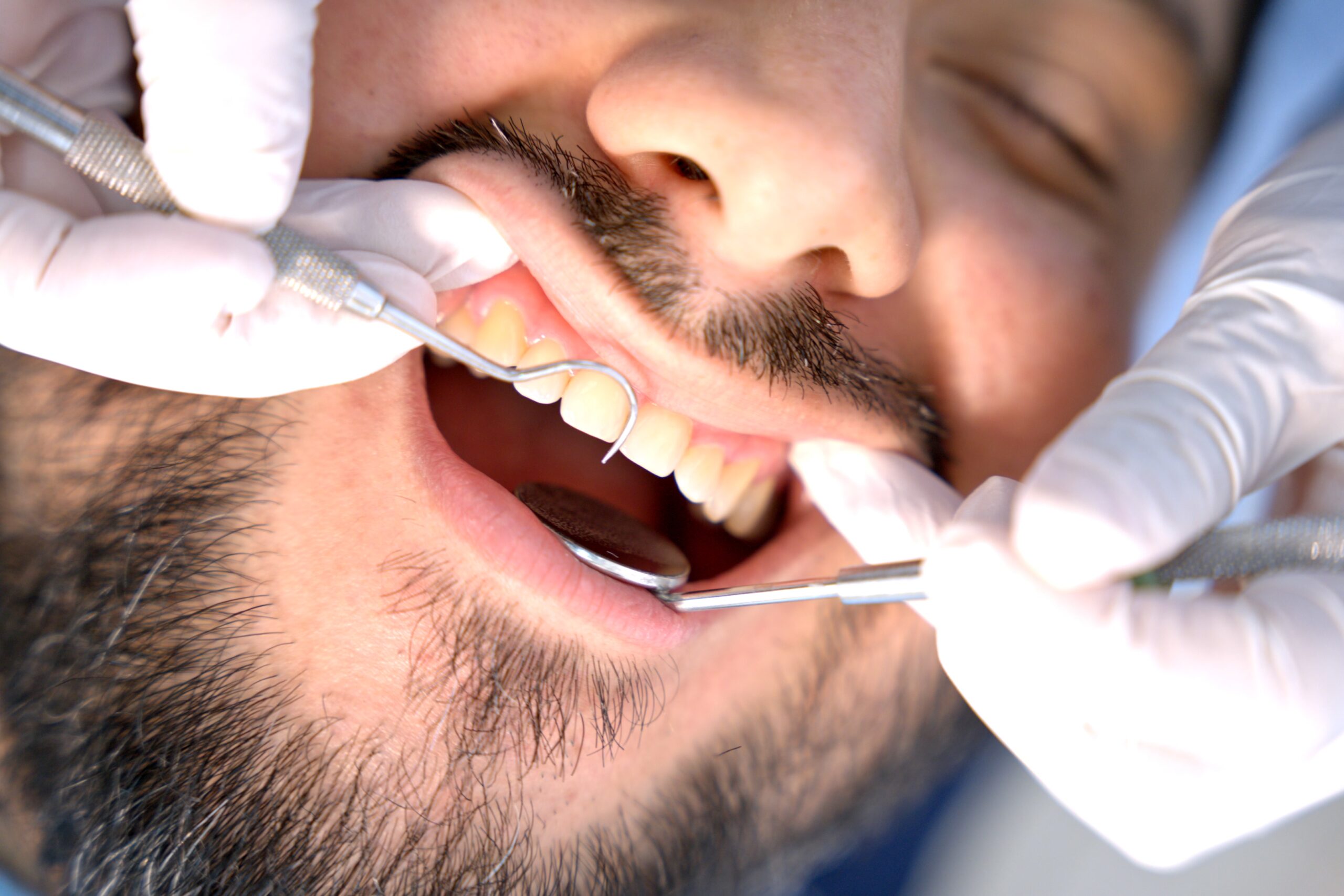 Limpieza dental profesional
