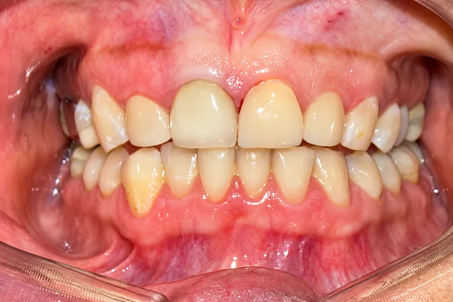 Resultado de carillas dentales en Clínica Dental Konamor