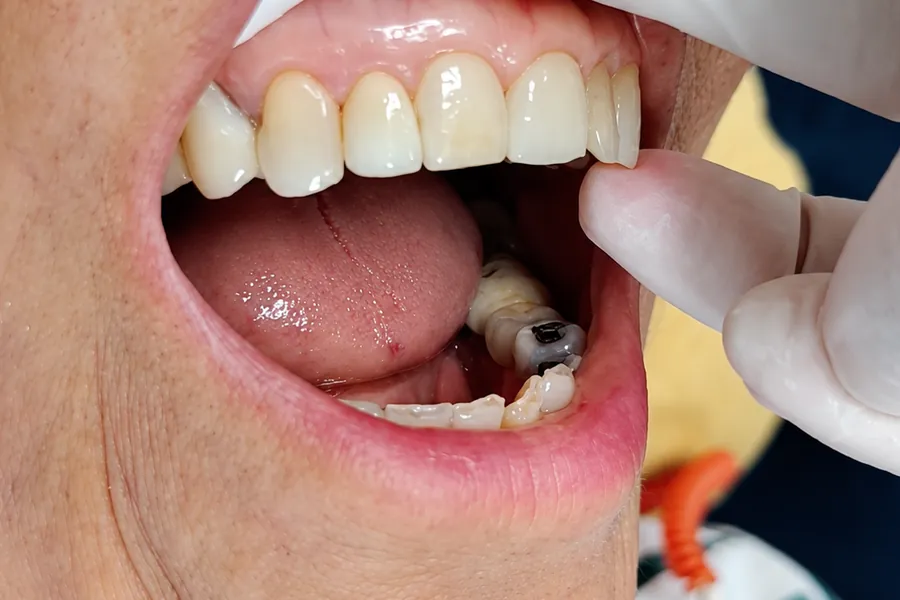 Implante dental real colocado en Clínica Dental Konamor