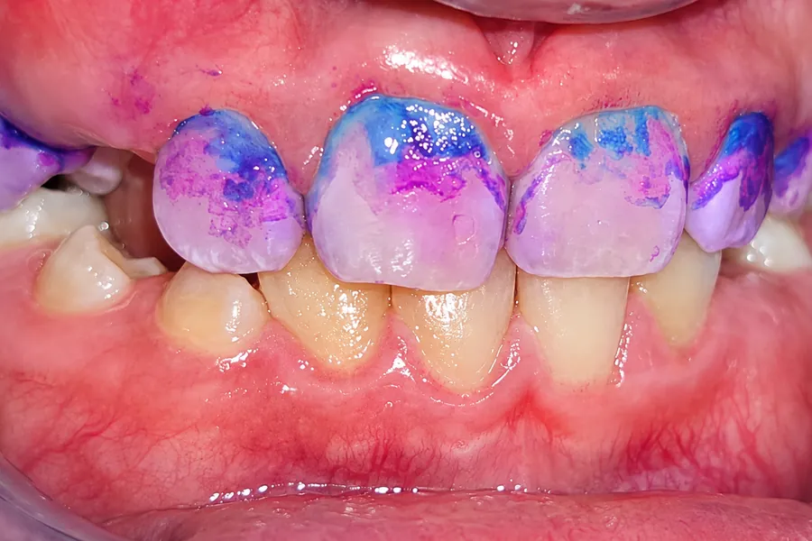 Revelador de placa durante una limpieza dental en Konamor