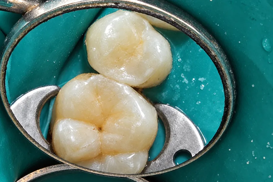 Relleno dental en molar con aislamiento en Clínica Dental Konamor